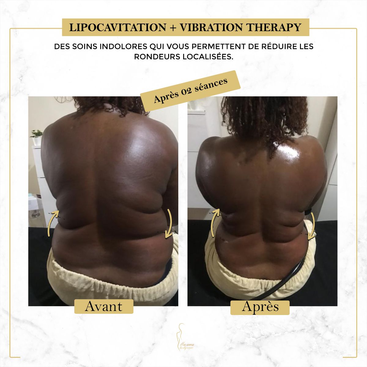Affinez Votre Silhouette Sans Chirurgie 2